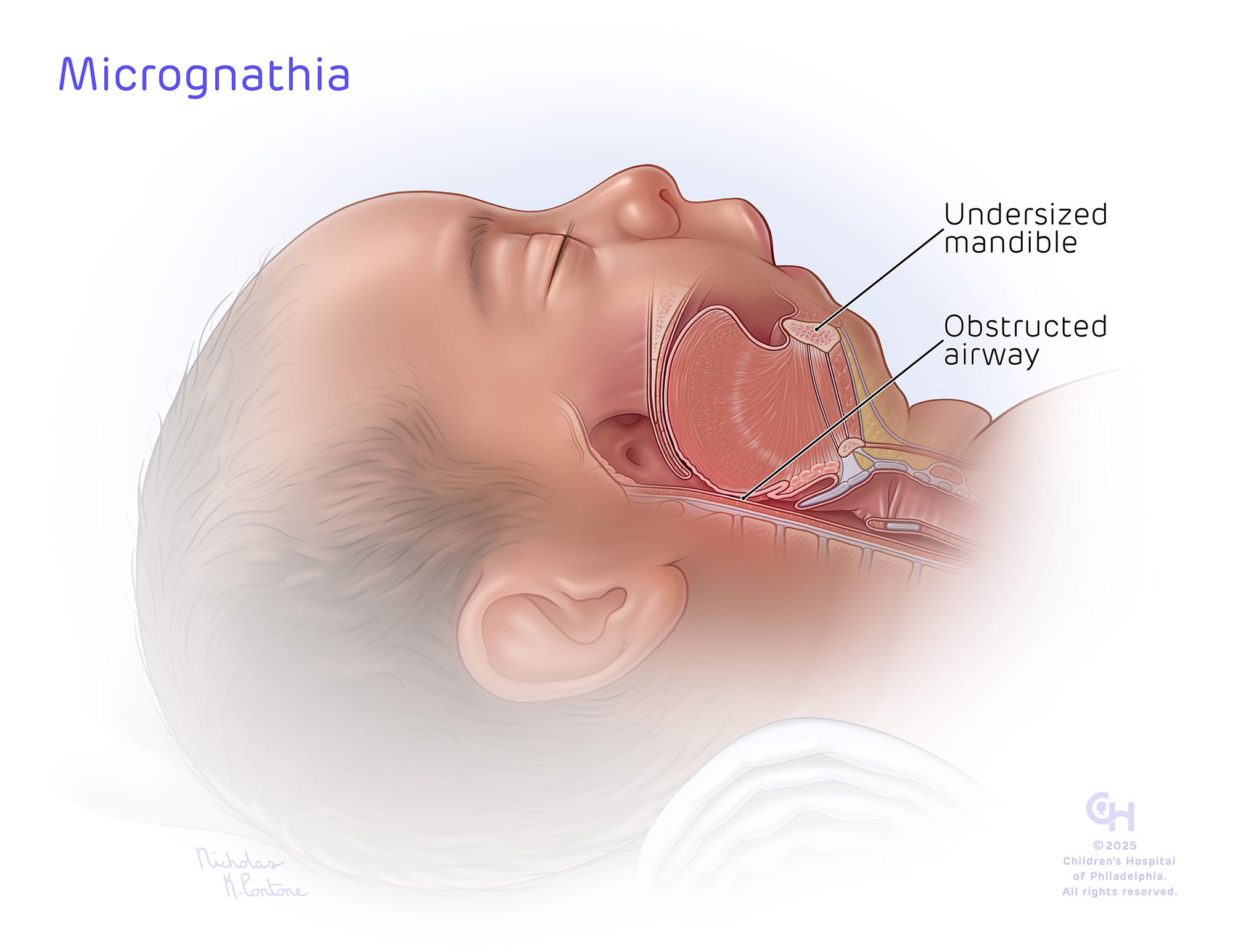 Micrognathia