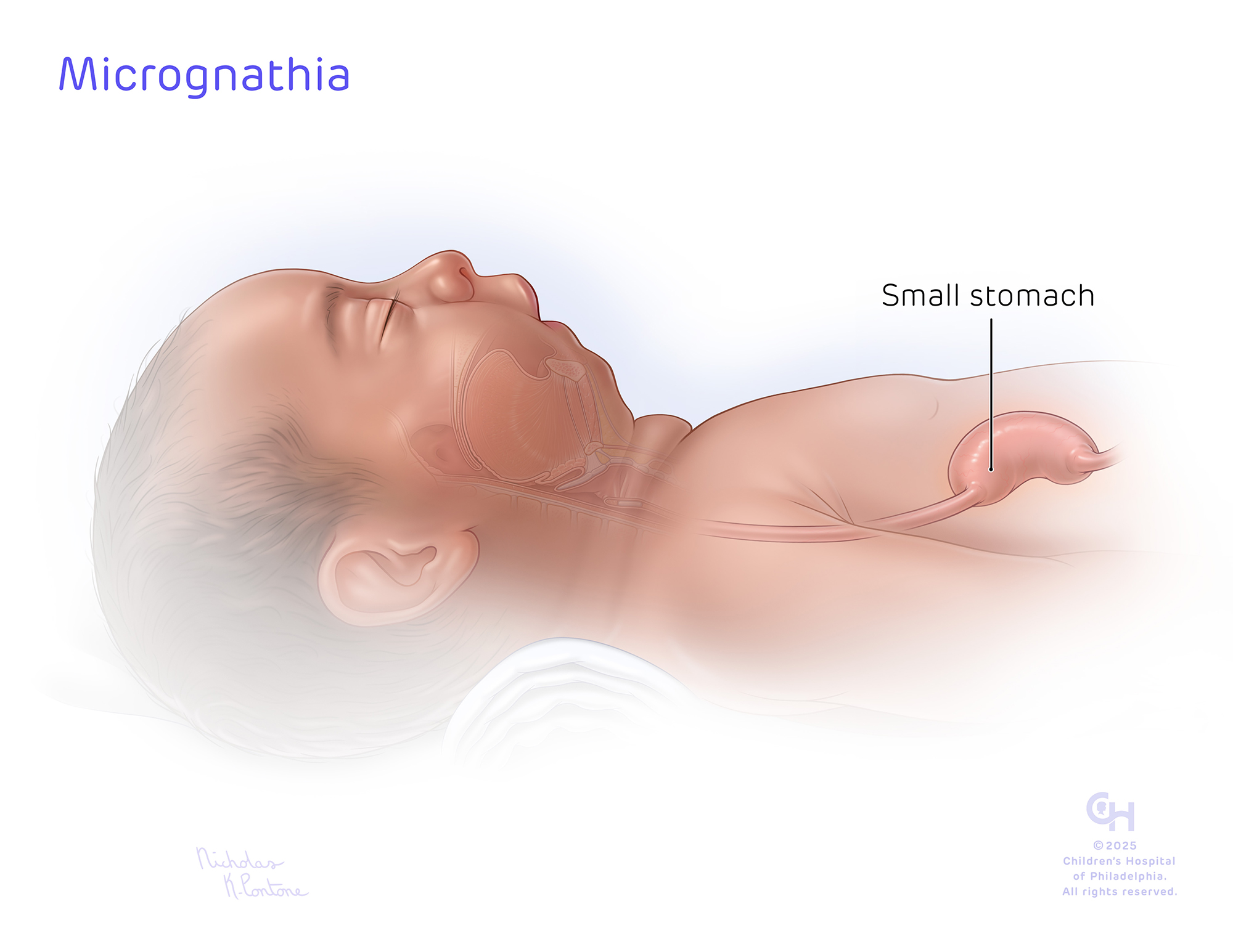 Micrognathia_Small stomach