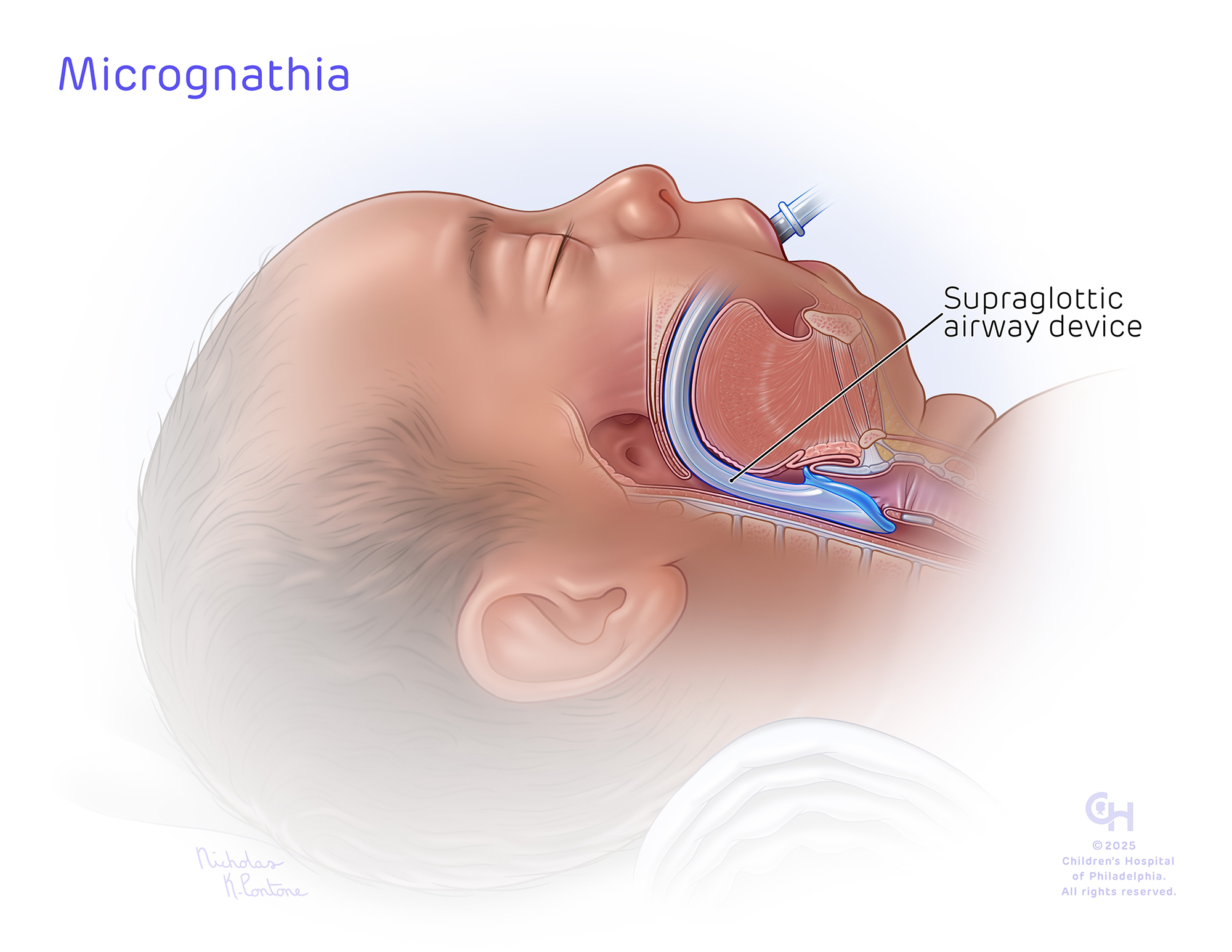 Micrognathia_Supraglottic airway device